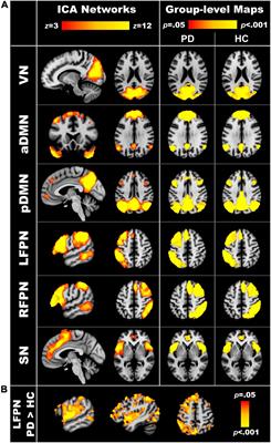 Internetwork Connectivity Predicts Cognitive Decline in Parkinson’s and Is Altered by Genetic Variants